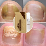 Load image into Gallery viewer, Fungus Relief Treatment Pen™